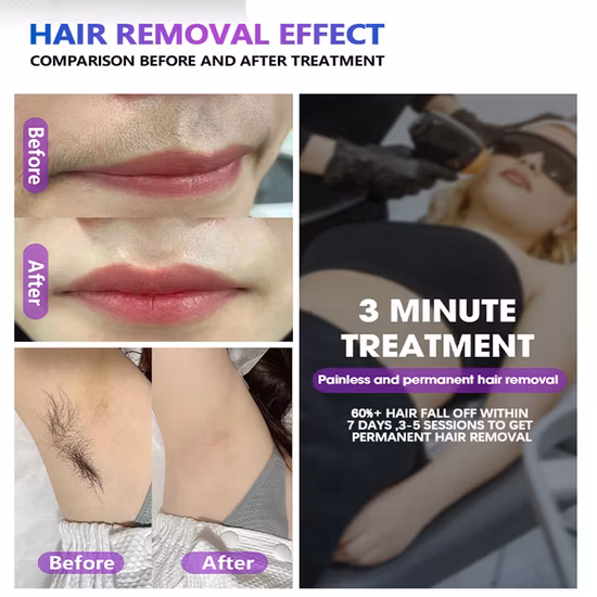 ダイオード レーザー脱毛 808nm 大出力アレキサンドライト レーザー 1800W 755 808 1064